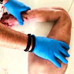 Träningsarm för tourniquet